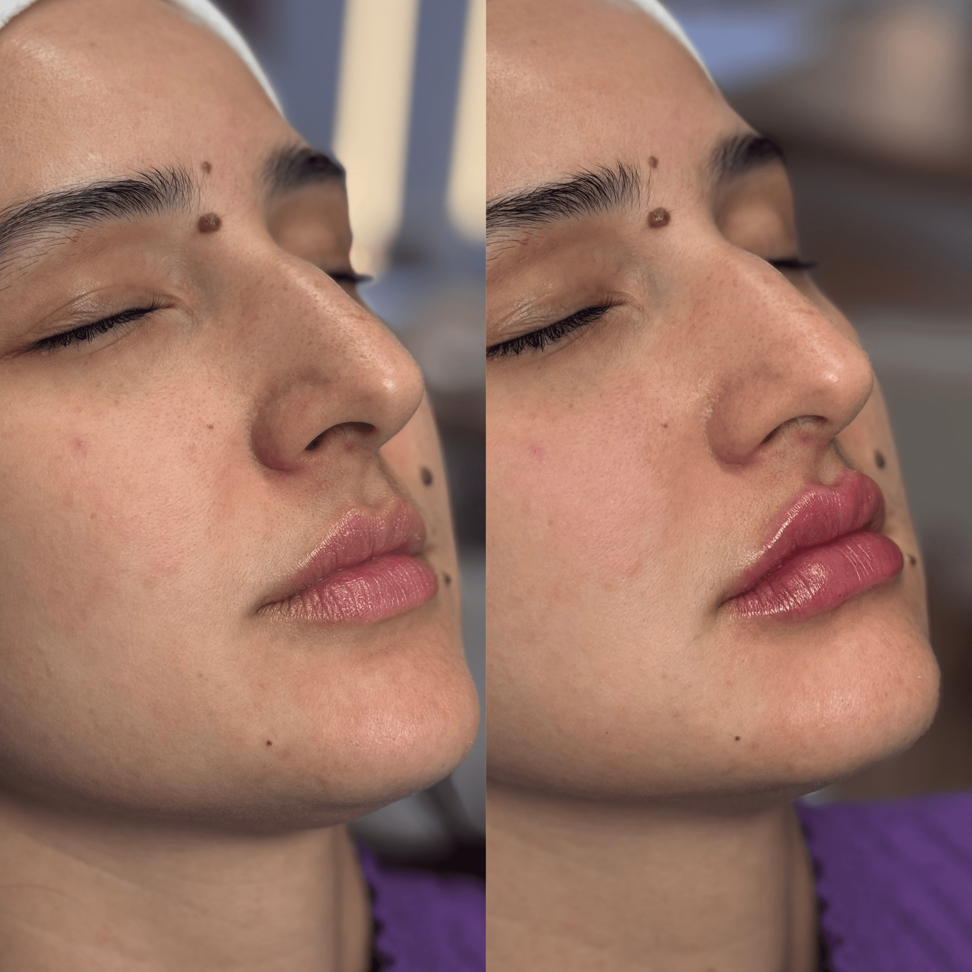 Resultado de harmonização facial