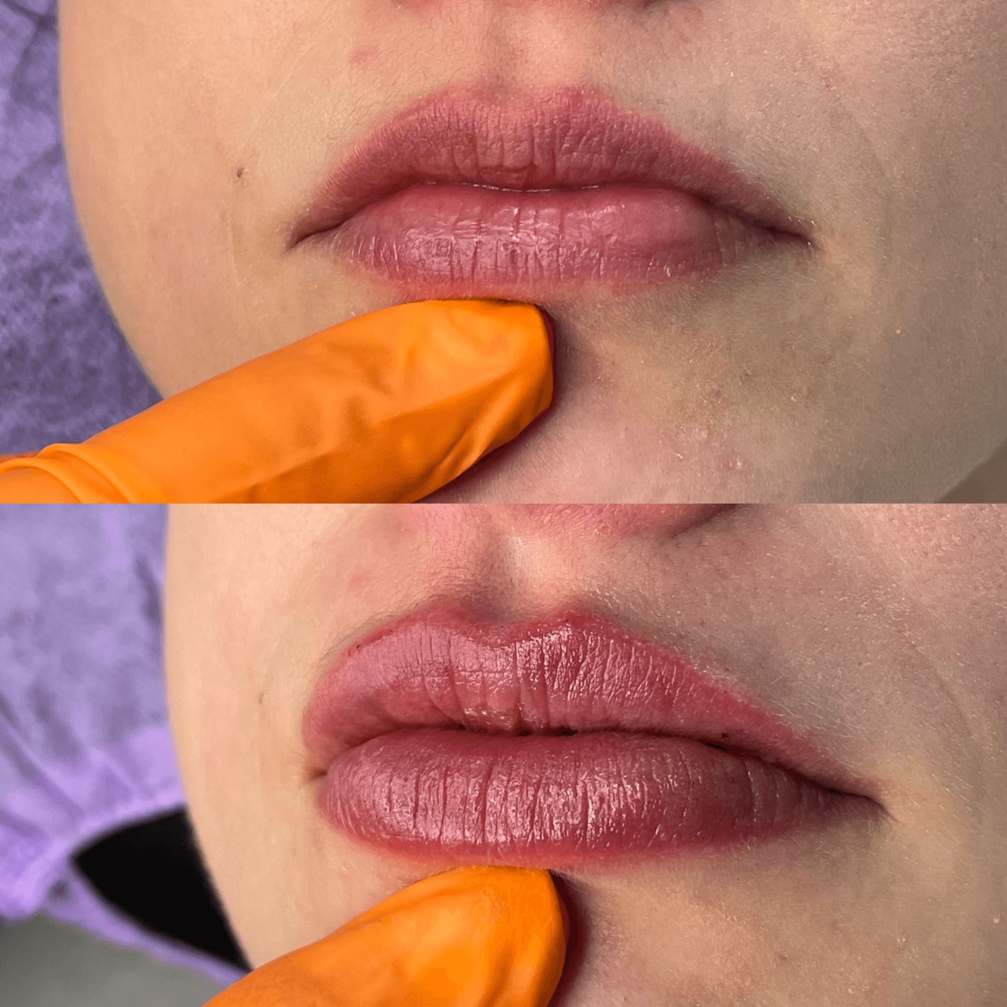 Resultado de harmonização facial