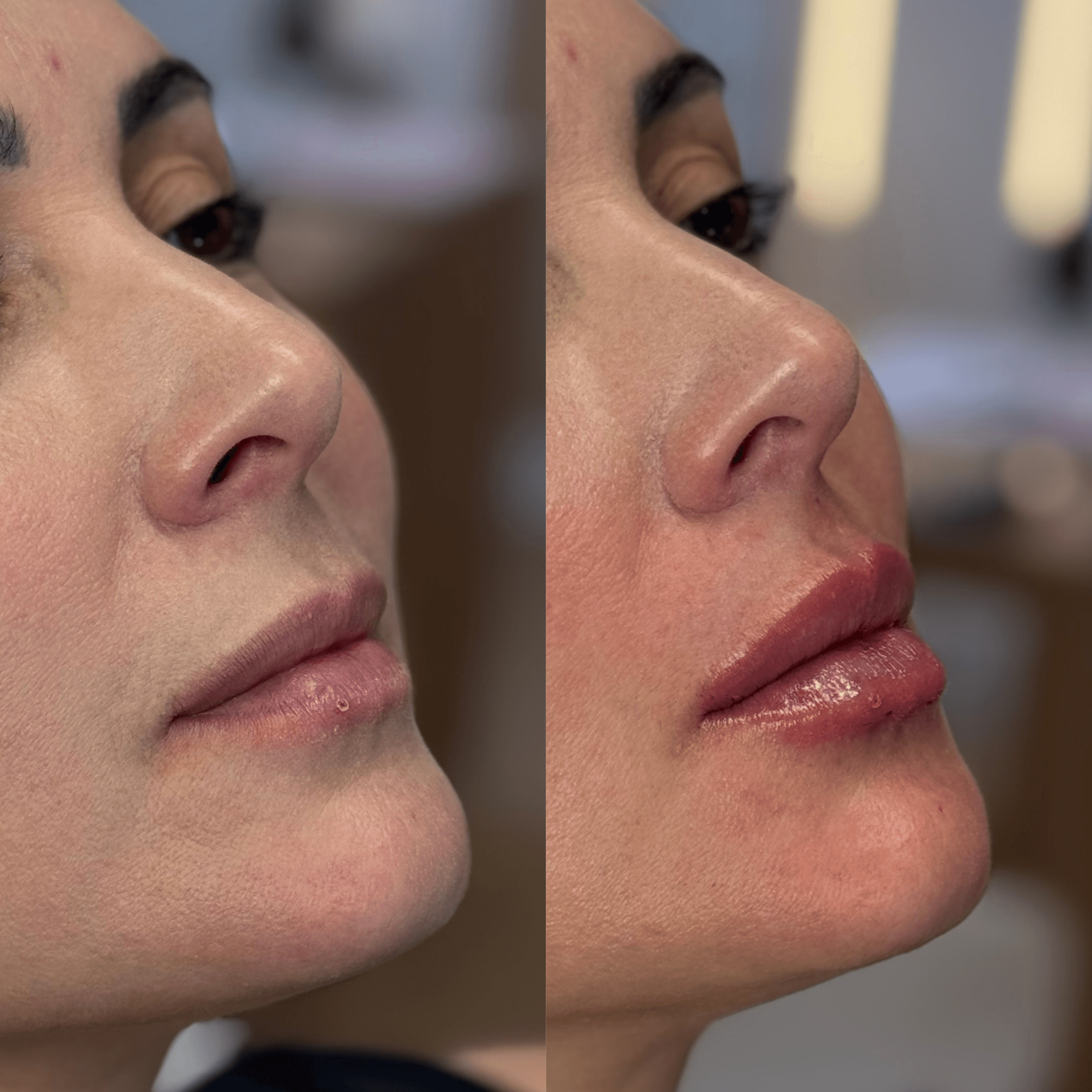 Resultado de harmonização facial