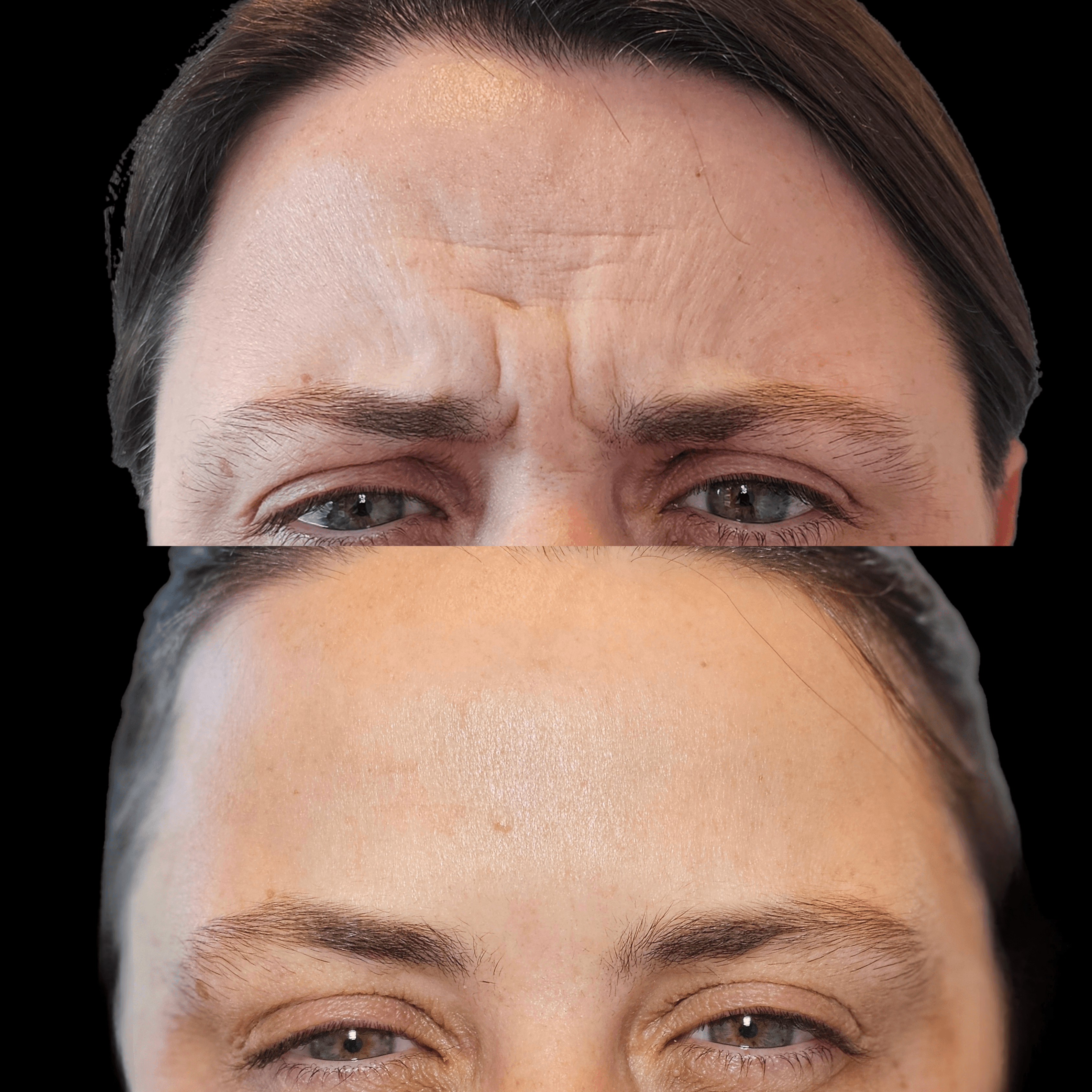 Resultado de harmonização facial