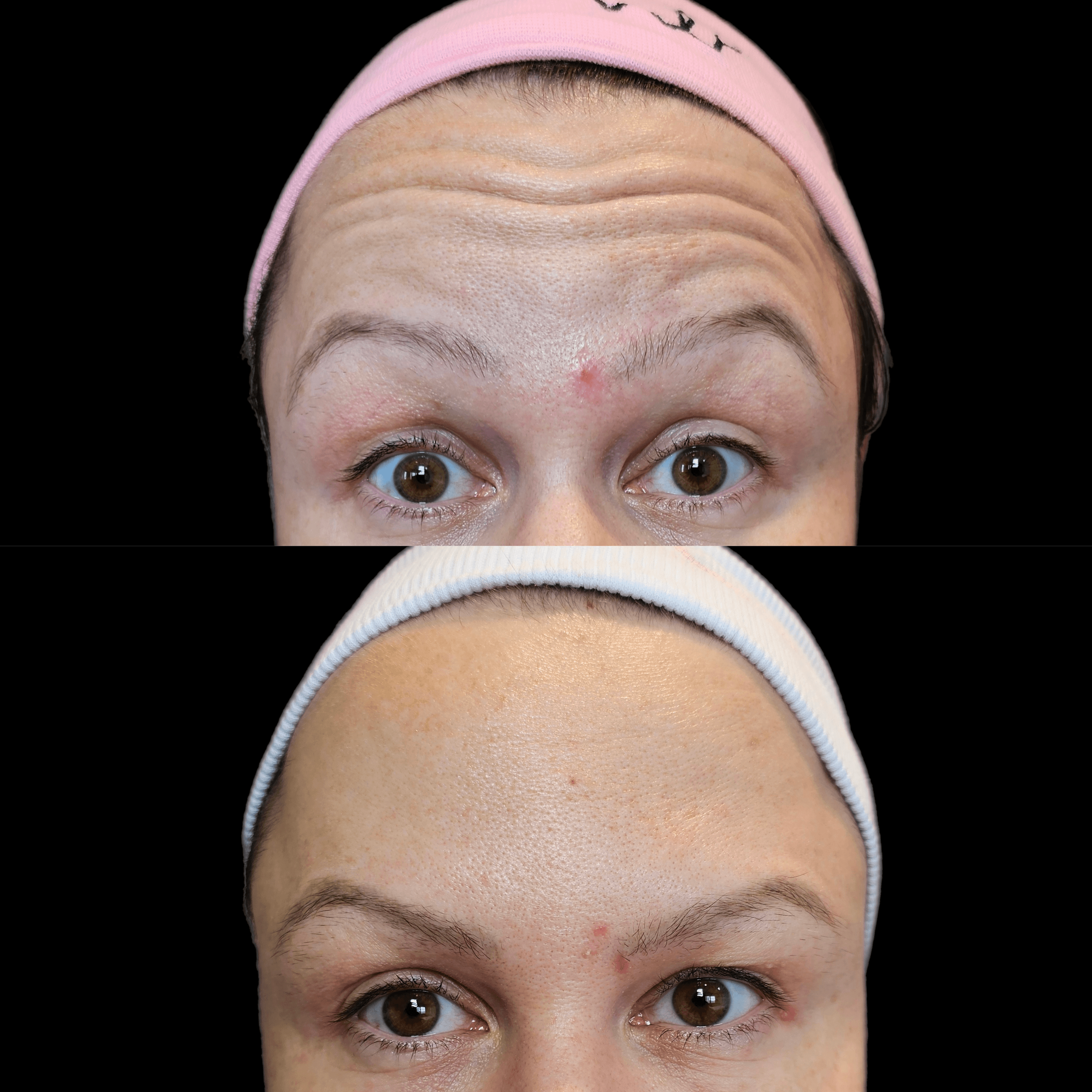 Resultado de harmonização facial