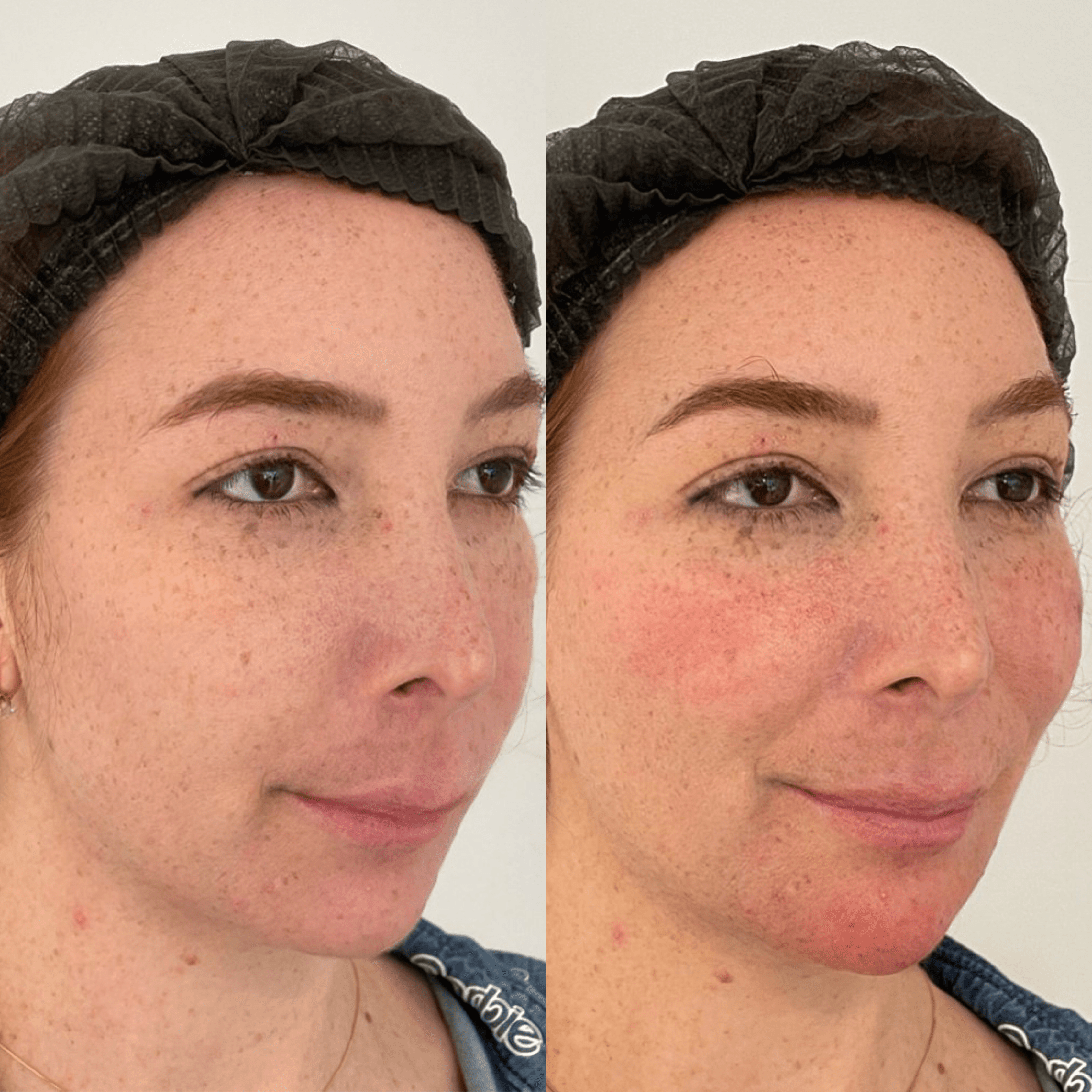 Resultado de harmonização facial