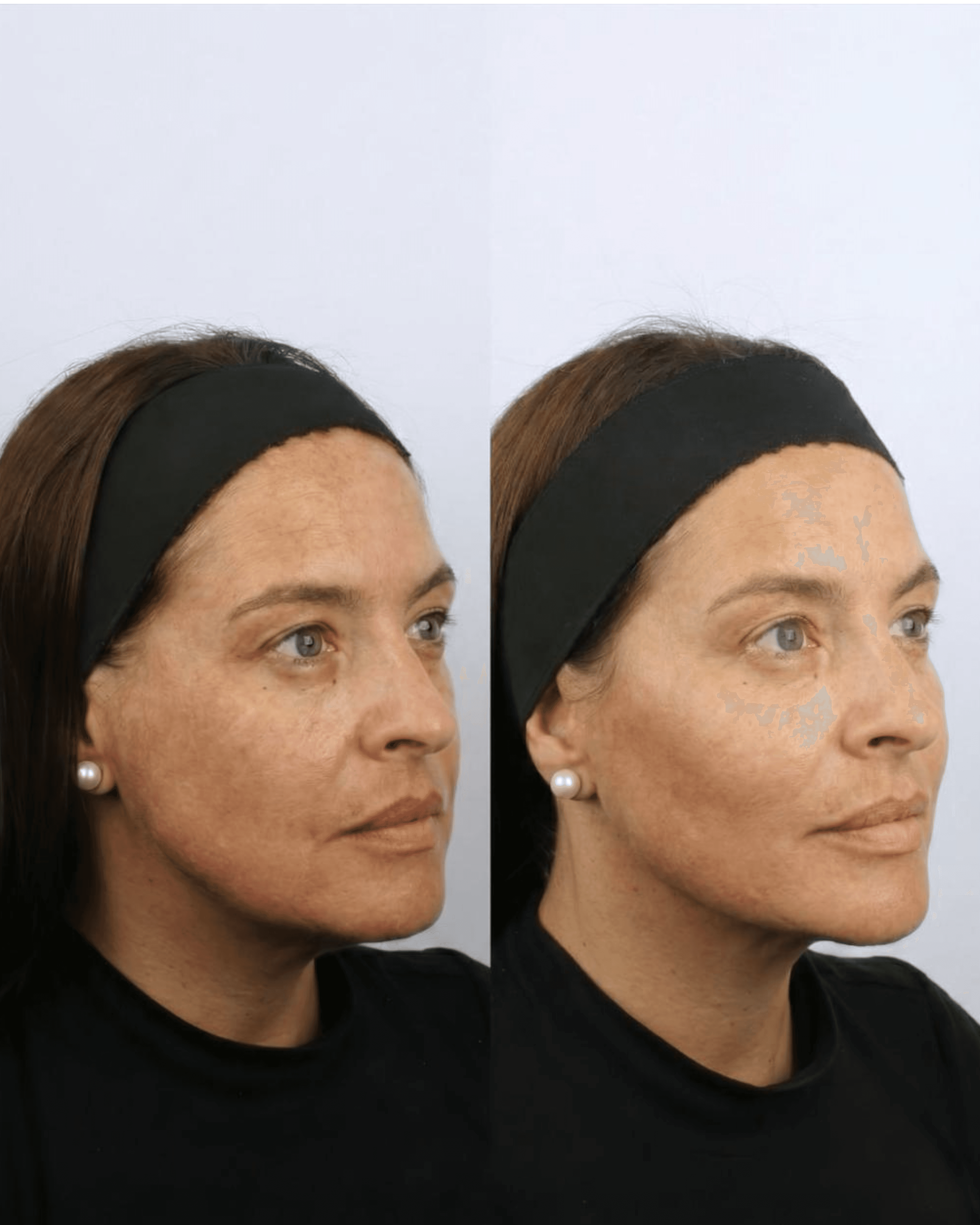 Resultado depois do procedimento